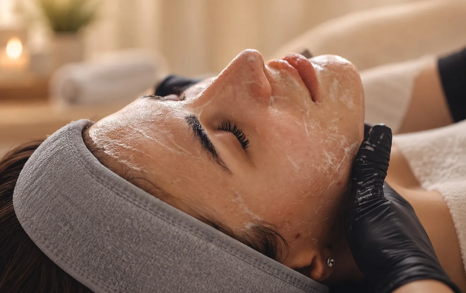 Peeling Químico